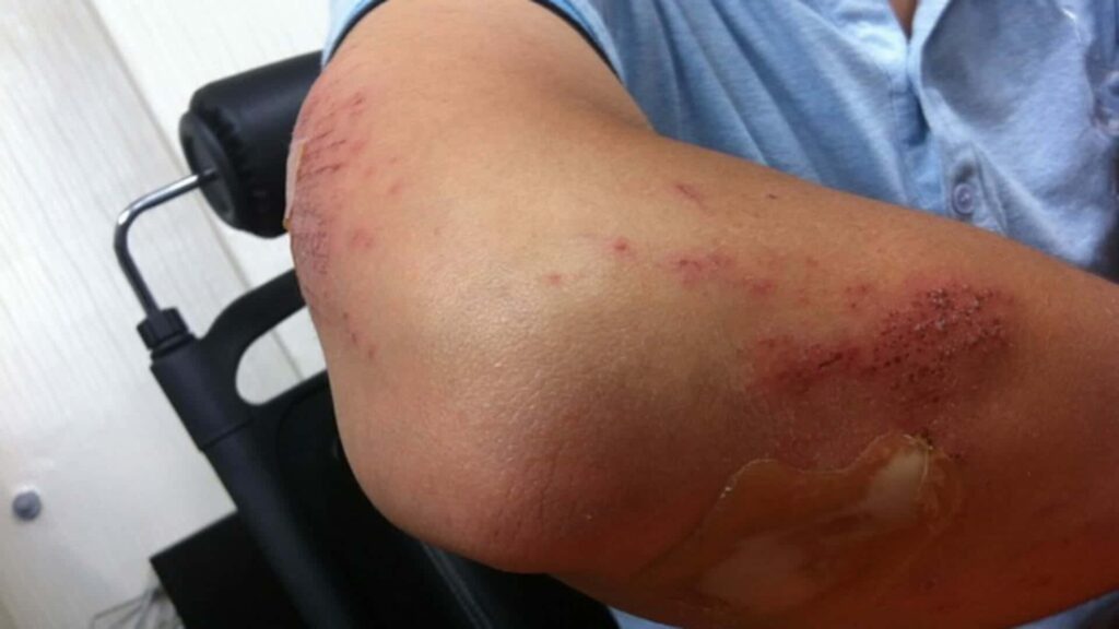 elbow injury