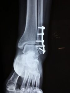Permanent Injury Virginia Workers' compensation